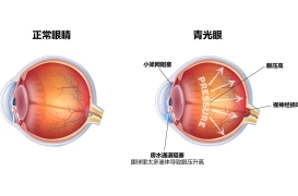 青光眼