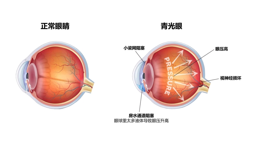 青光眼